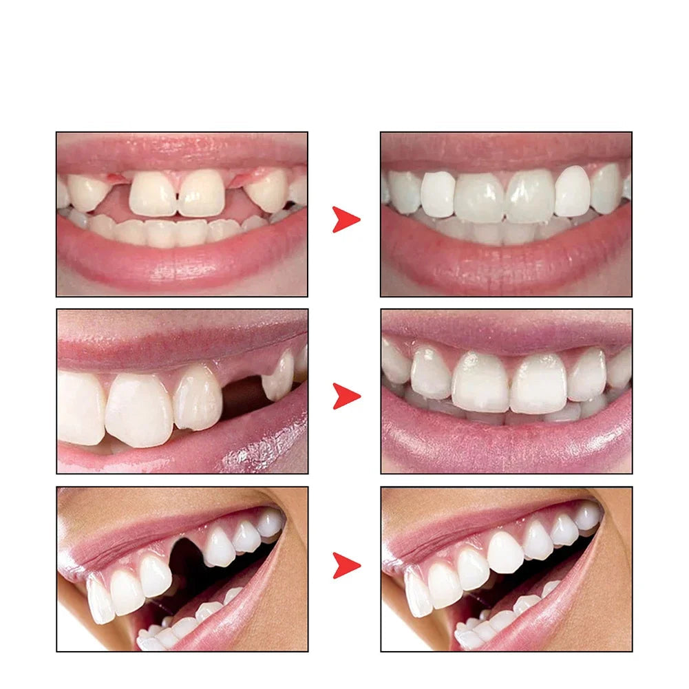 Żywica do Naprawy Zębów