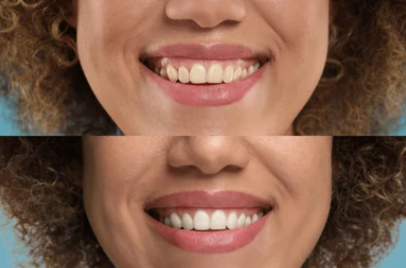 Fioletowe Paski Wybielające Zęby