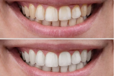 Fioletowe Paski Wybielające Zęby