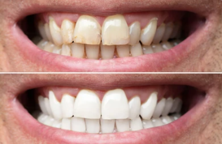 Fioletowe Paski Wybielające Zęby